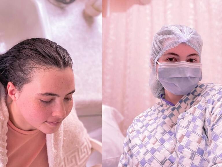 Joven mujer de 25 años cuenta el calvario de vivir con alergia al agua: «Salía de la ducha con enormes ronchas en la piel»