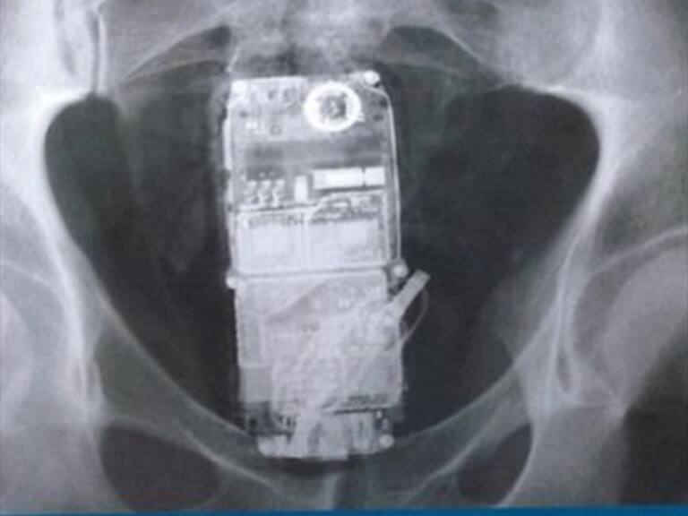 Este es el listado de objetos «atorados» en el cuerpo de pacientes estadounidenses