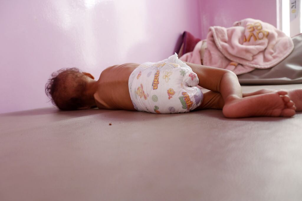 Un niño en Yemen enfrenta la desnutrición que sufre en plena crisis humanitaria
