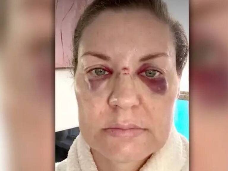 Axl Rose lanza micrófono al público y deja a una fanática con los ojos morados y la nariz rota