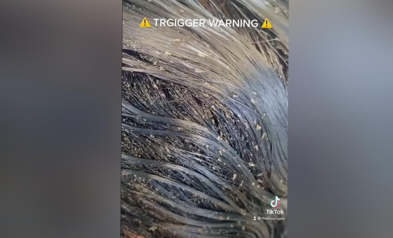 Impactante video viral muestra a niña con miles de piojos en su cabeza