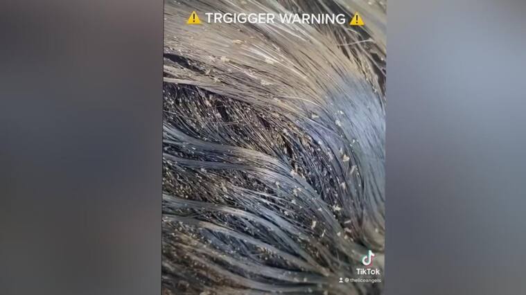 Impactante video viral muestra a niña con miles de piojos en su cabeza