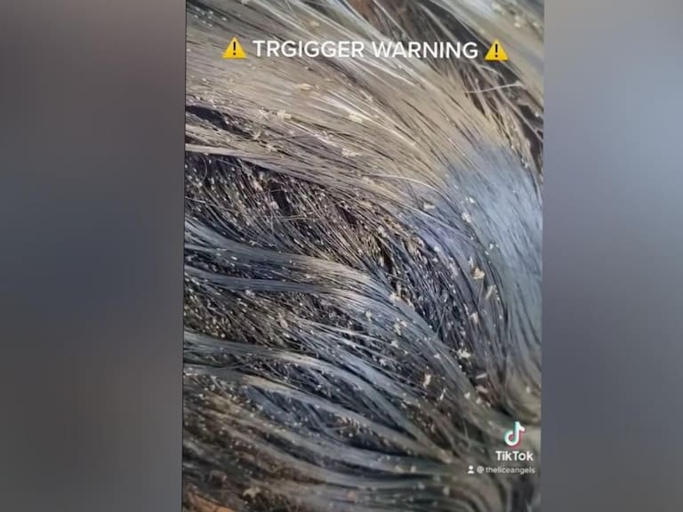 Impactante video viral muestra a niña con miles de piojos en su cabeza