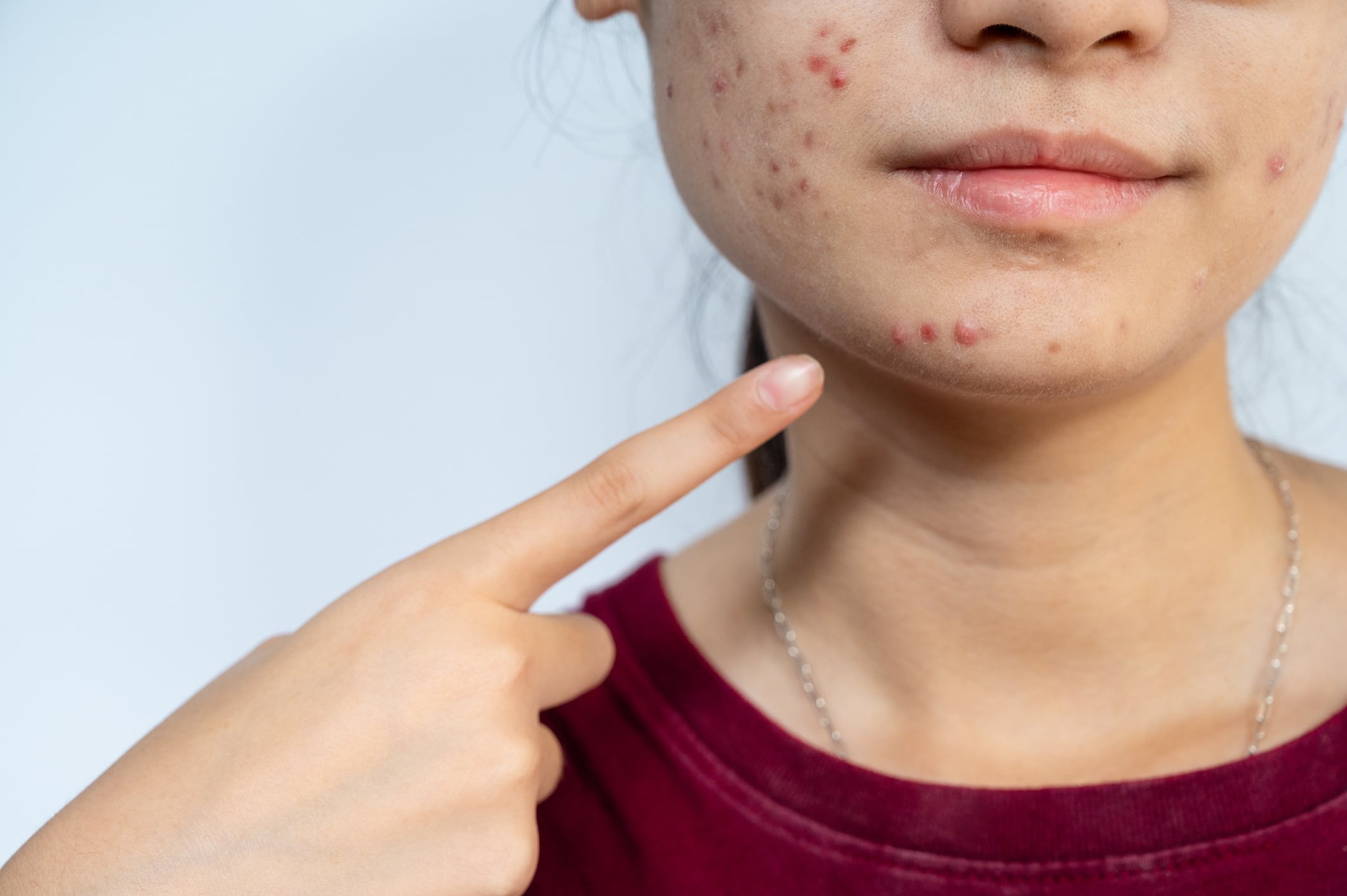 Soy dermatóloga y esta es la única forma correcta de reventarte una espinilla (sin causar graves problemas en tu piel)