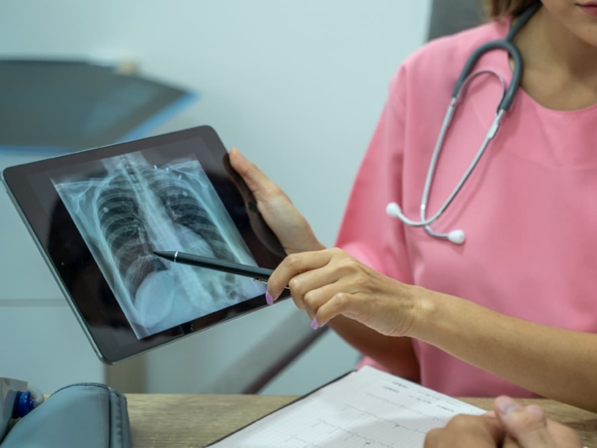 Alerta por tuberculosis en Chile: confirman tres contagios en Biobío y Coquimbo y activan protocolos de seguridad