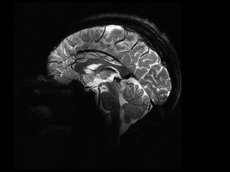 Este tipo de bebidas (que la mayoría consume) podría provocar un accidente cerebrovascular, según estudio