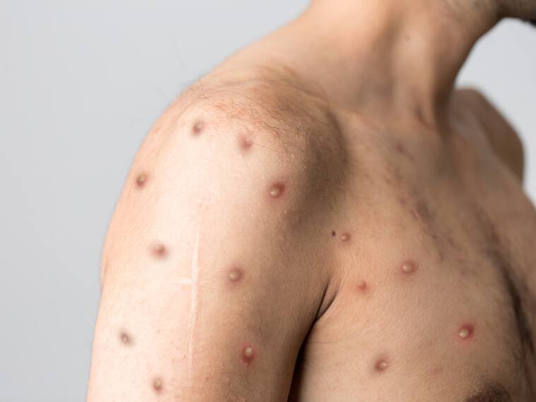 Monkeypox new disease dangerous over the world. High quality photo
