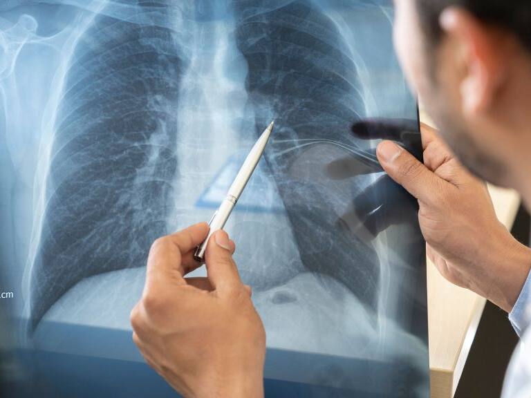 Qué es la EPOC, la compleja Enfermedad Pulmonar Obstructiva Crónica que es la tercera causa de muerte en el mundo