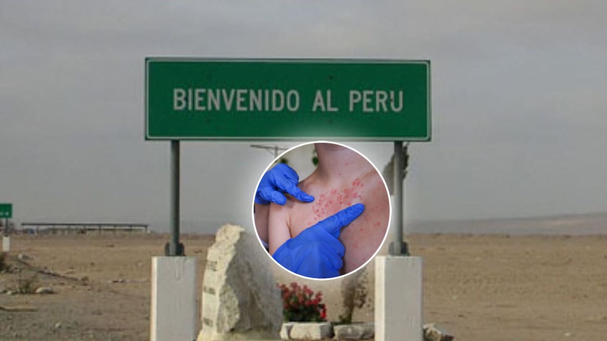 Brote de sarampión en Perú