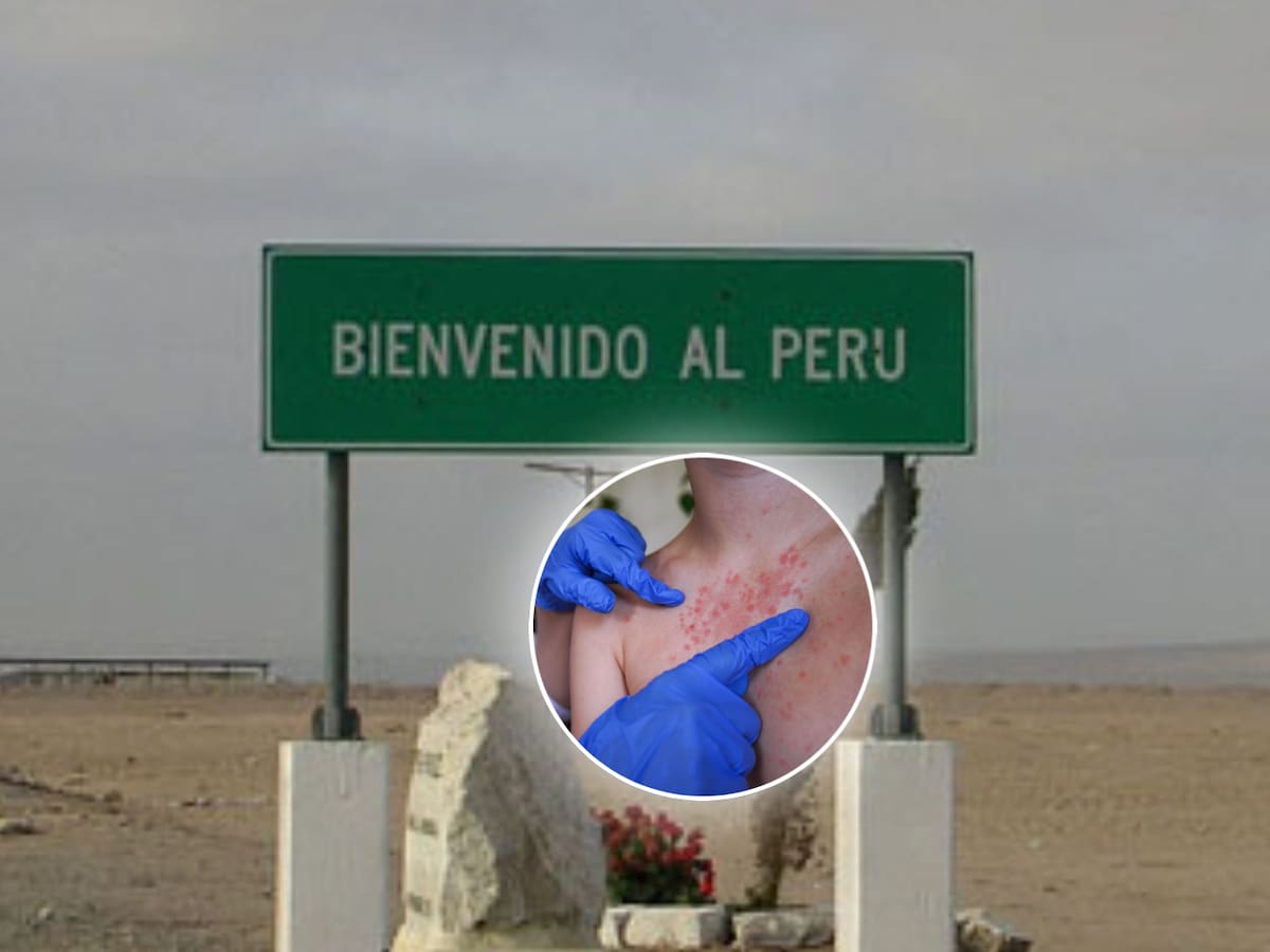 Alerta sanitaria en el extremo norte: seremi de Salud advierte riesgo por brote de sarampión en Perú