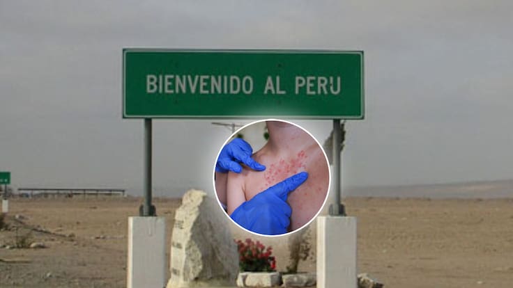 Brote de sarampión en Perú