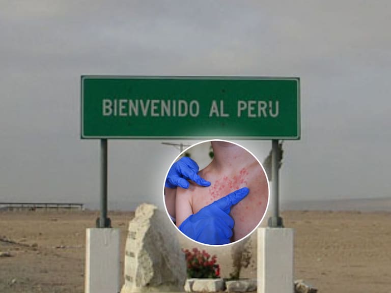 Brote de sarampión en Perú