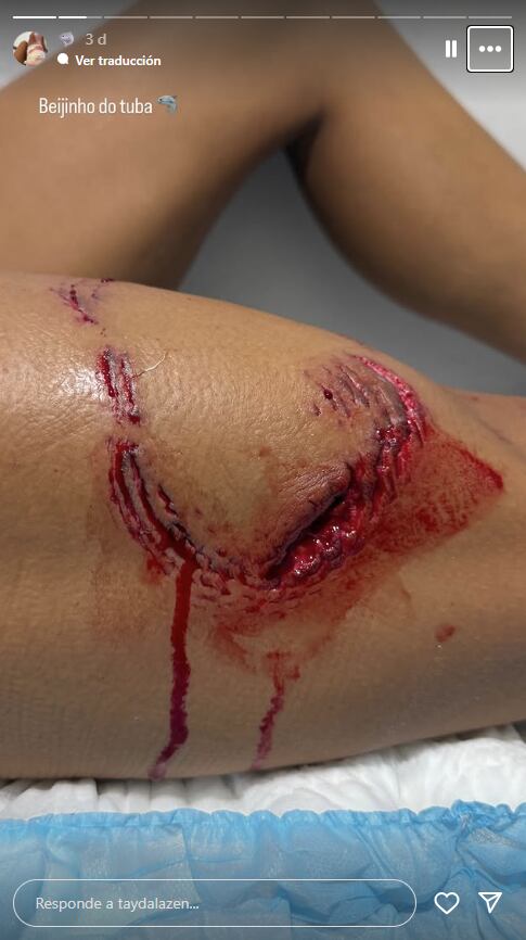 Turista es mordida por tiburón mientras hacía esnórquel en Brasil