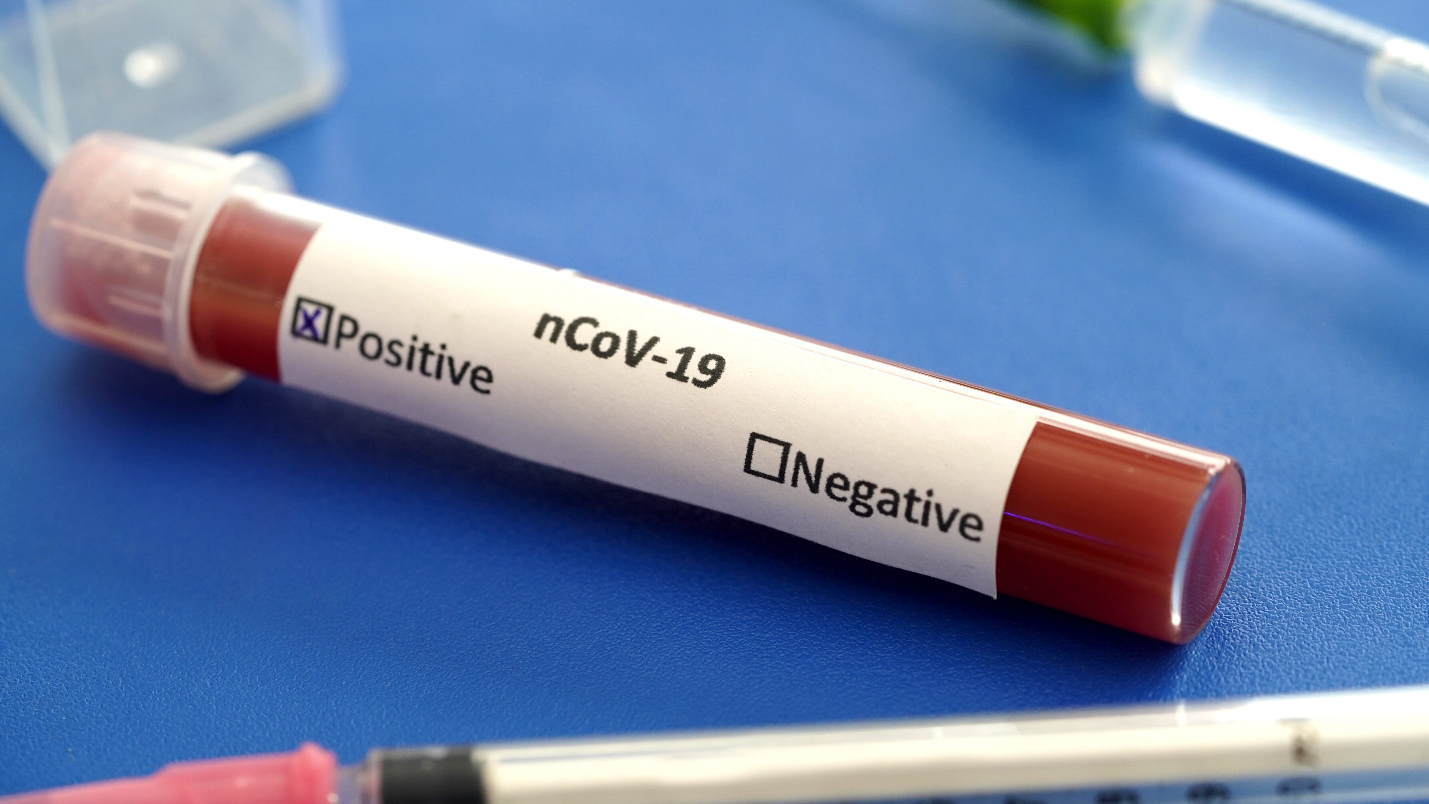 COVID19 test and laboratory sample of blood testing for diagnosis new Corona virus infection