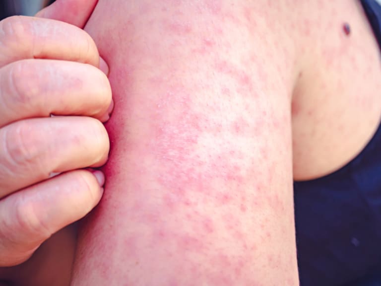 Measles, Women scratch the upper arm with one hand due to the numerous red pruritus., Measles is a disease that can spread easily.