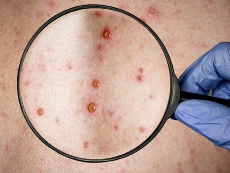 Medios italianos reportan contagio de ciudadano chileno con viruela del mono