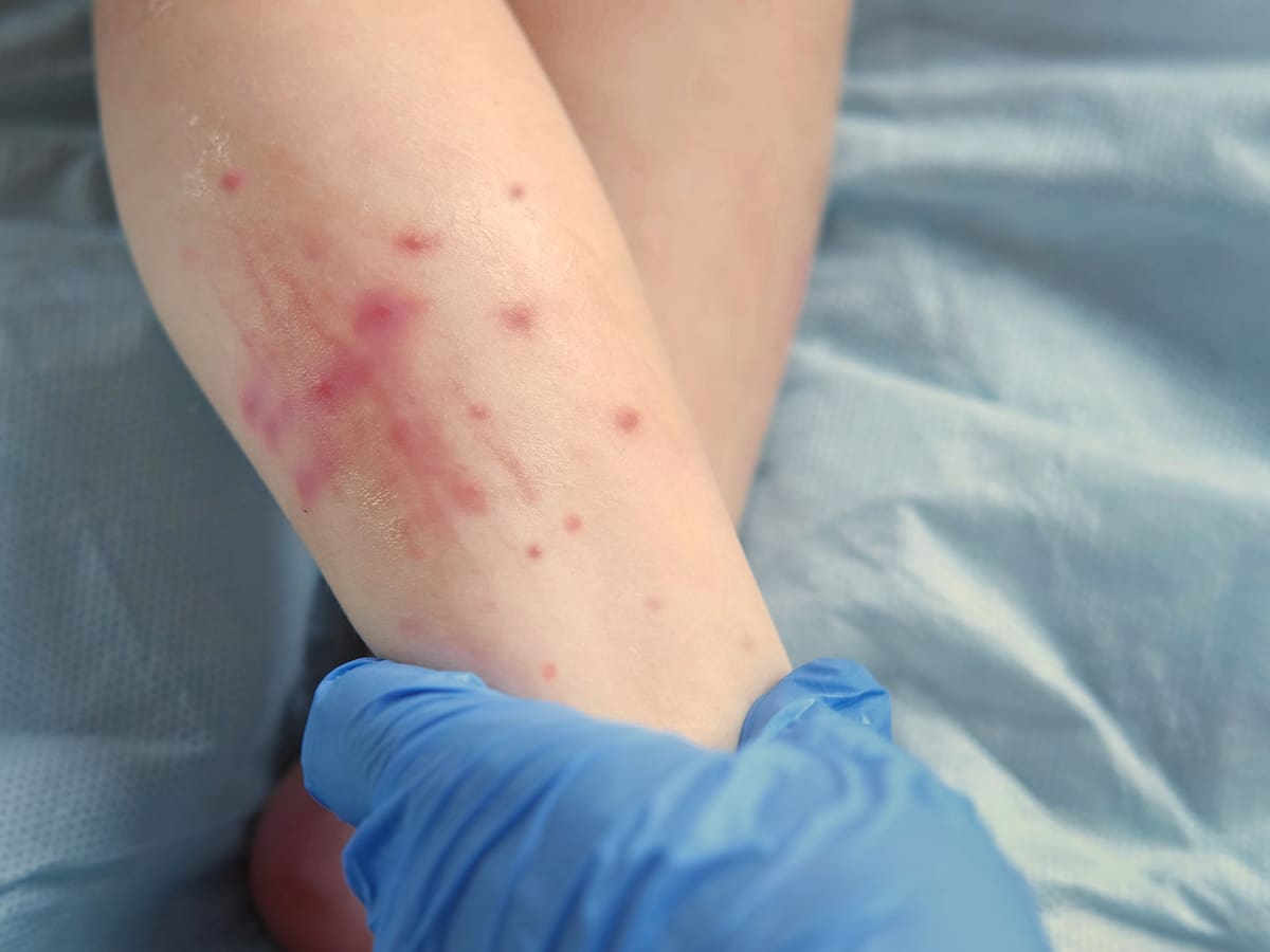 Minsal emite alerta epidemiológica por aumento de sarampión en países vecinos y hace un llamado a cumplir con el esquema de vacunación completo