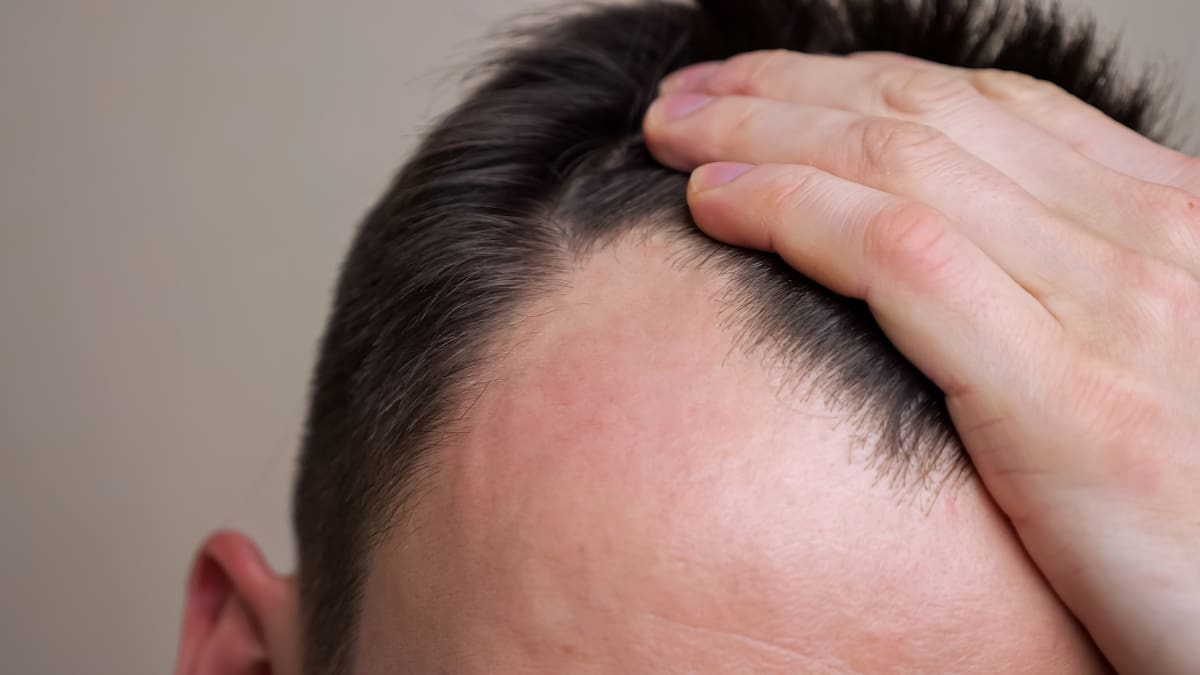 ¿El sol acelera la caída del pelo? Experto aclara qué le ocurre al cabello y cuáles son los factores que aceleran todo