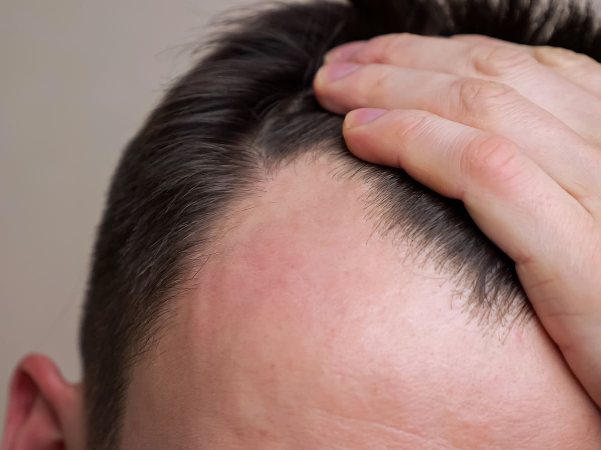 ¿El sol acelera la caída del pelo? Experto aclara qué le ocurre al cabello y cuáles son los factores que aceleran todo