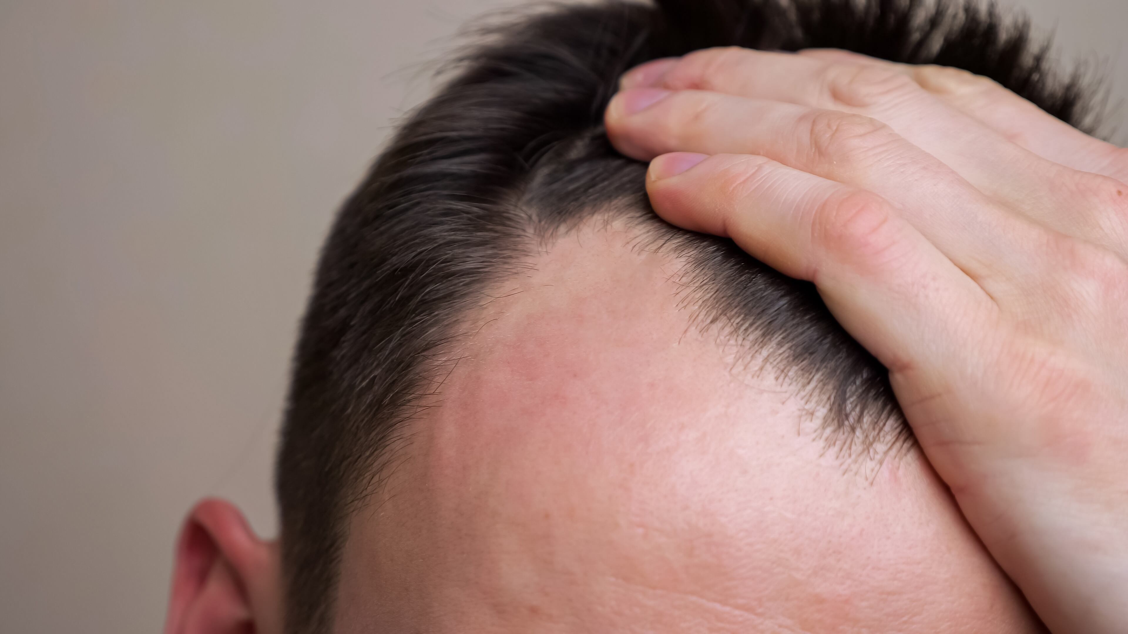 ¿El sol acelera la caída del pelo? Experto aclara qué le ocurre al cabello y cuáles son los factores que aceleran todo