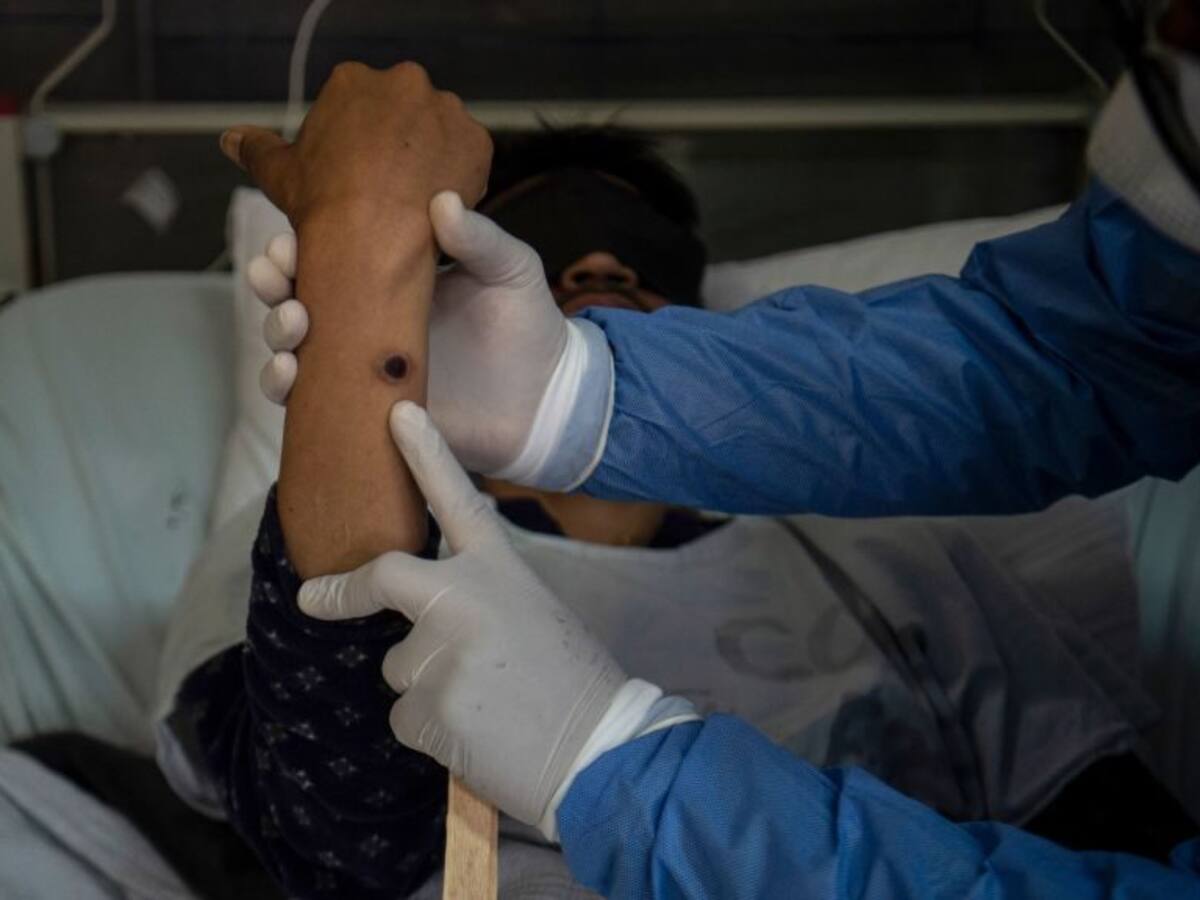 Perú acumula más de 1.000 contagios de la viruela del mono